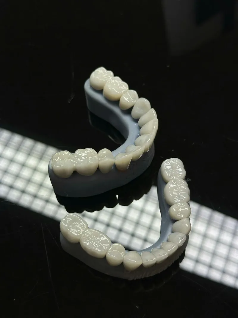 Porcelain veneer shells crafted in a dental laboratory — the premium e.max ceramic material used for dental veneers at safe clinics in Turkey, saving UK patients thousands